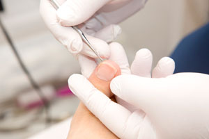 前橋市でケア実績多数。巻き爪ケアの評判が高い